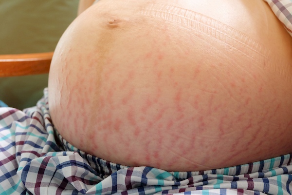 pregnant with twins and stretchmarks