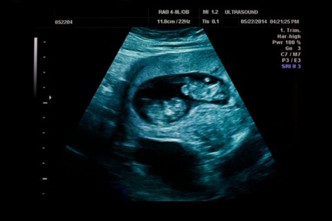 Can Identical Twins Be Opposite Genders? | Multiple Birth | Twinfo