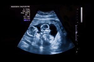 Can Identical Twins Be Opposite Genders? | Multiple Birth | Twinfo