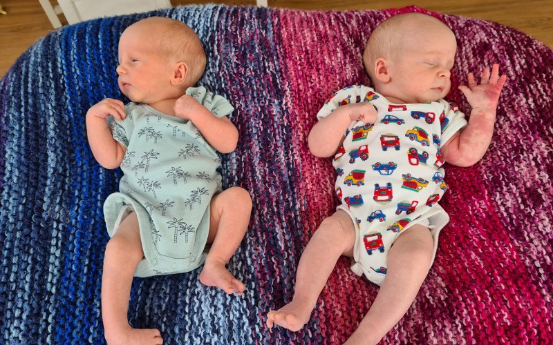 One identical twin with clubfoot