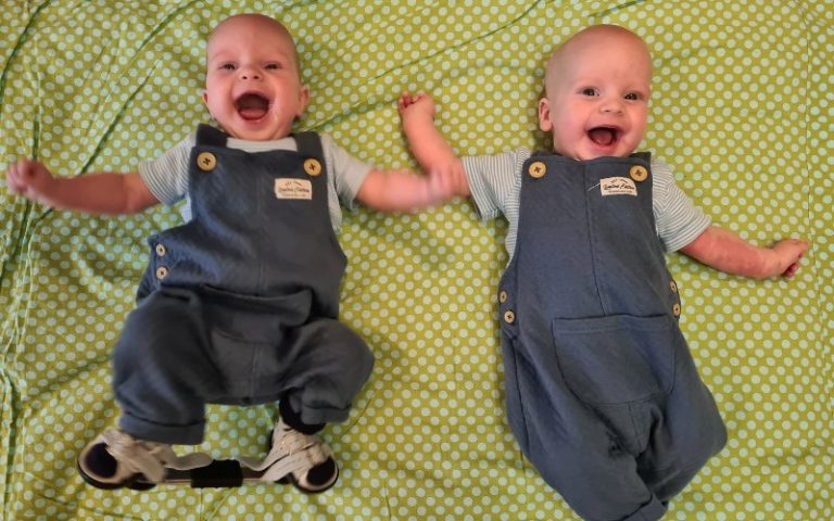 identical twins clubfoot in one twin