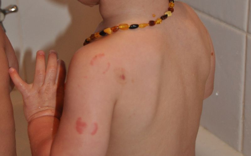 Triplets who bite each other