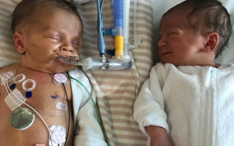 twins and Congenital Diaphragmatic Hernia