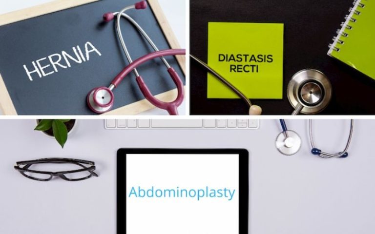 abdominal separation and abdominoplasty after twins