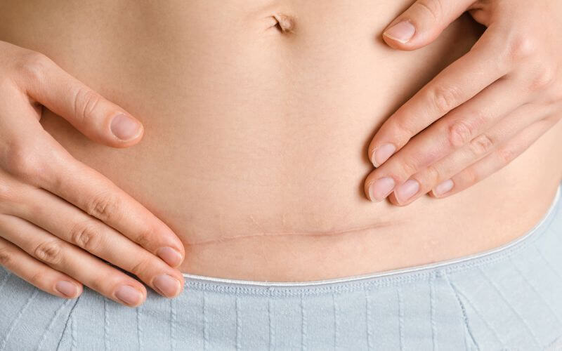 Twin C-section experience for new mums of multiples