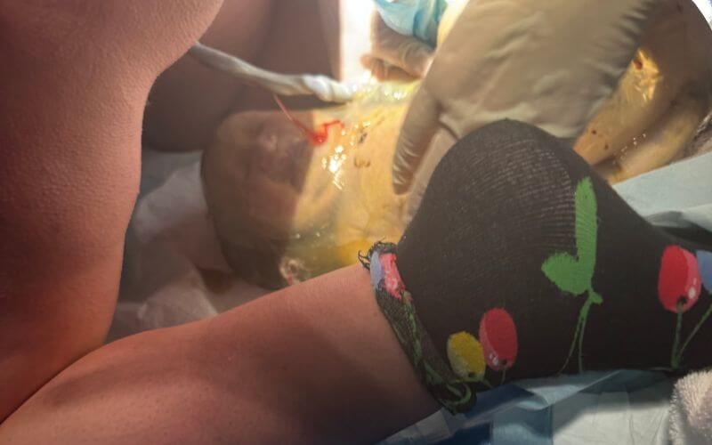 Twin born en caul at 41 weeks