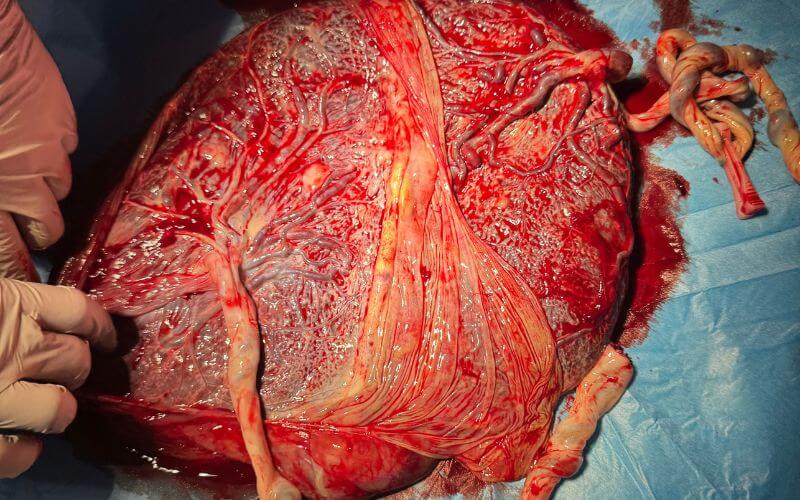 placenta of twins born at 41 weeks